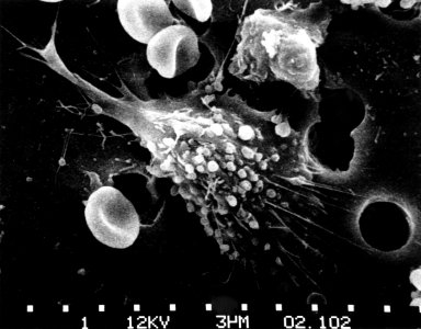 Cancer cells- death (step 1) photo
