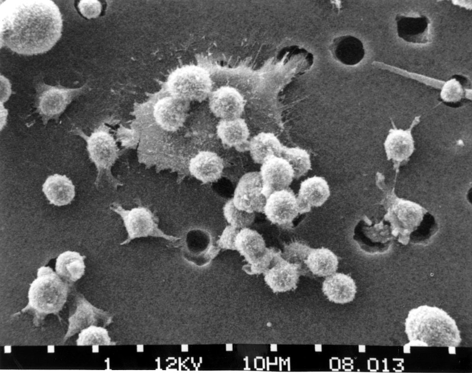 Cancer cells- death (step 2)