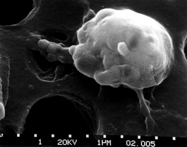 Cancer cells- death (step 5)
