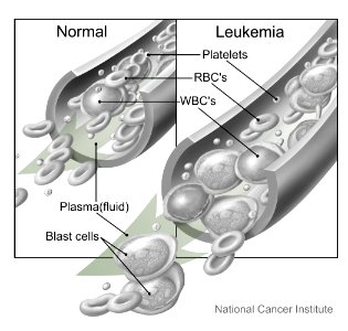 Blood cells (normal and leukemia) photo