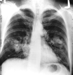 Chest x-ray (cancer) photo