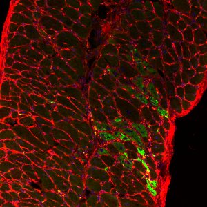 Duchenne Muscular Dystrophy (35122690776)