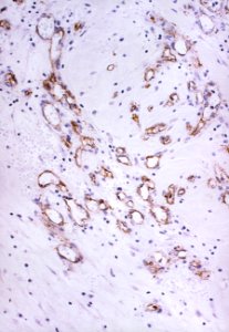 Ductal carcinoma histology