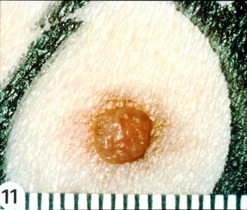 Dysplastic nevi (1)