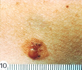 Dysplastic nevi