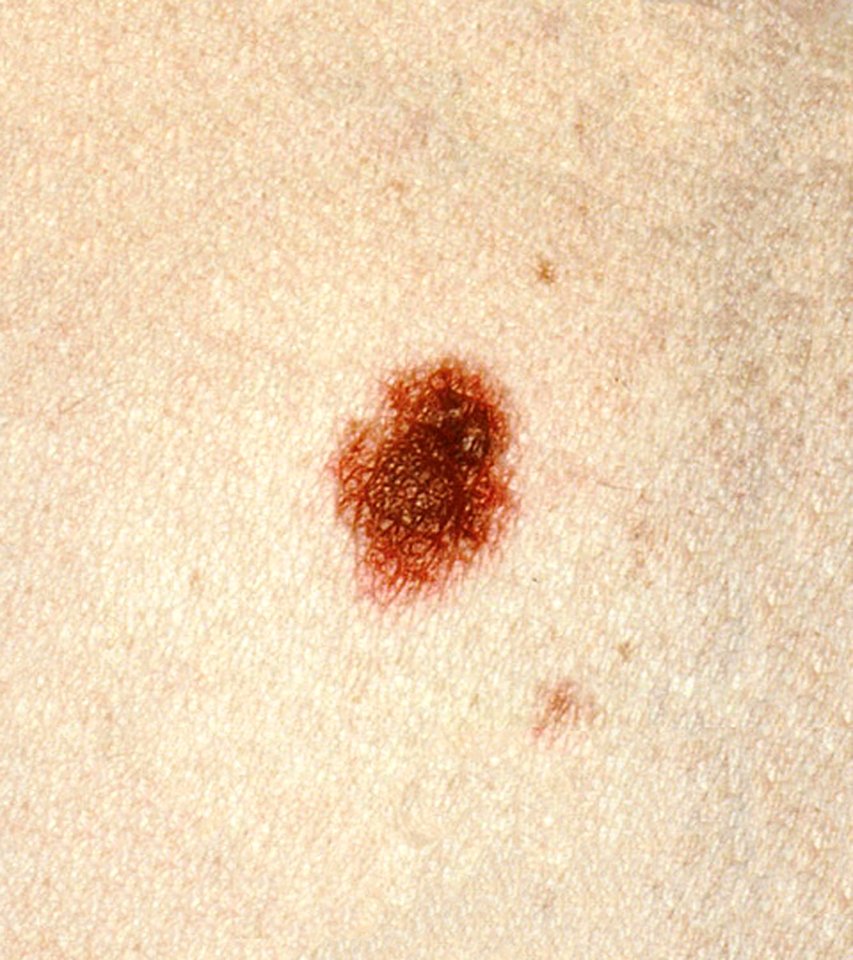 Dysplastic nevi (2)