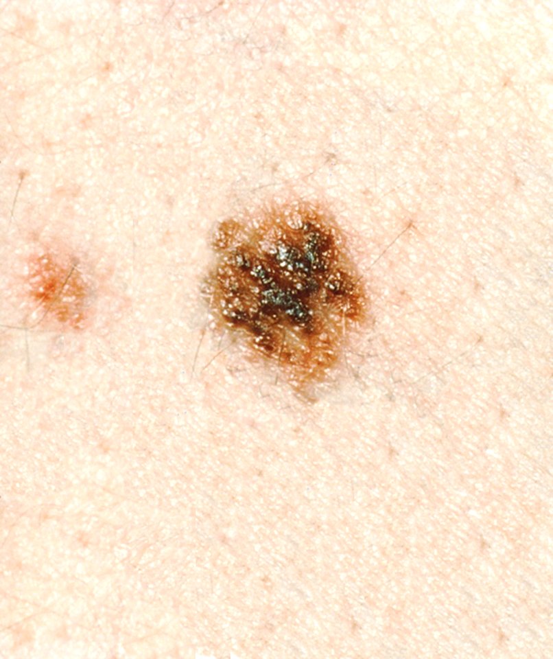 Dysplastic nevi (3)