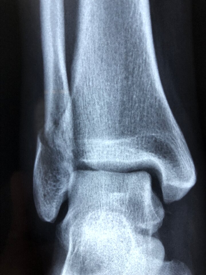 Injury radiology bone