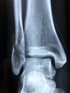 Injury radiology bone photo