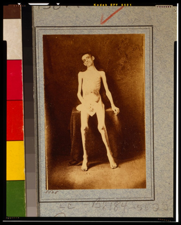 Emaciated prisoner of war from Belle Isle, Richmond, Private William M. Smith of Co. D of 8th Kentucky Volunteers, at the U.S. General Hospital, Div. 1, Annapolis LCCN2013645514