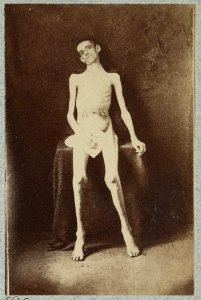 Emaciated prisoner of war from Belle Isle, Richmond, Private William M. Smith of Co. D of 8th Kentucky Volunteers, at the U.S. General Hospital, Div. 1, Annapolis LCCN2013645514