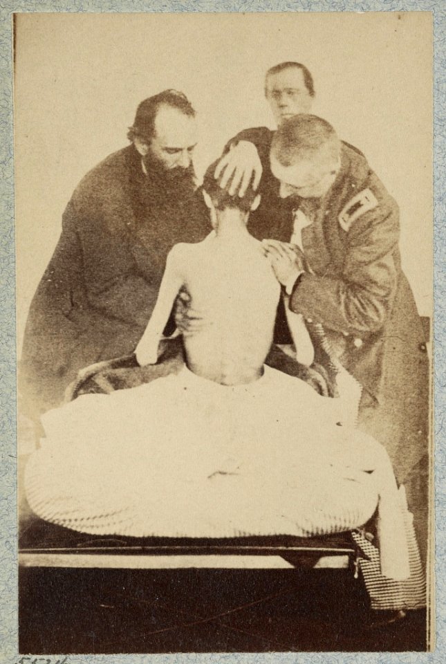 Emaciated prisoner of war from Belle Isle, Richmond, Private Isaiah G. Bowker of Co. B, 9th Maine Volunteers, at the U.S. General Hospital, Div. 1, Annapolis LCCN2013645511