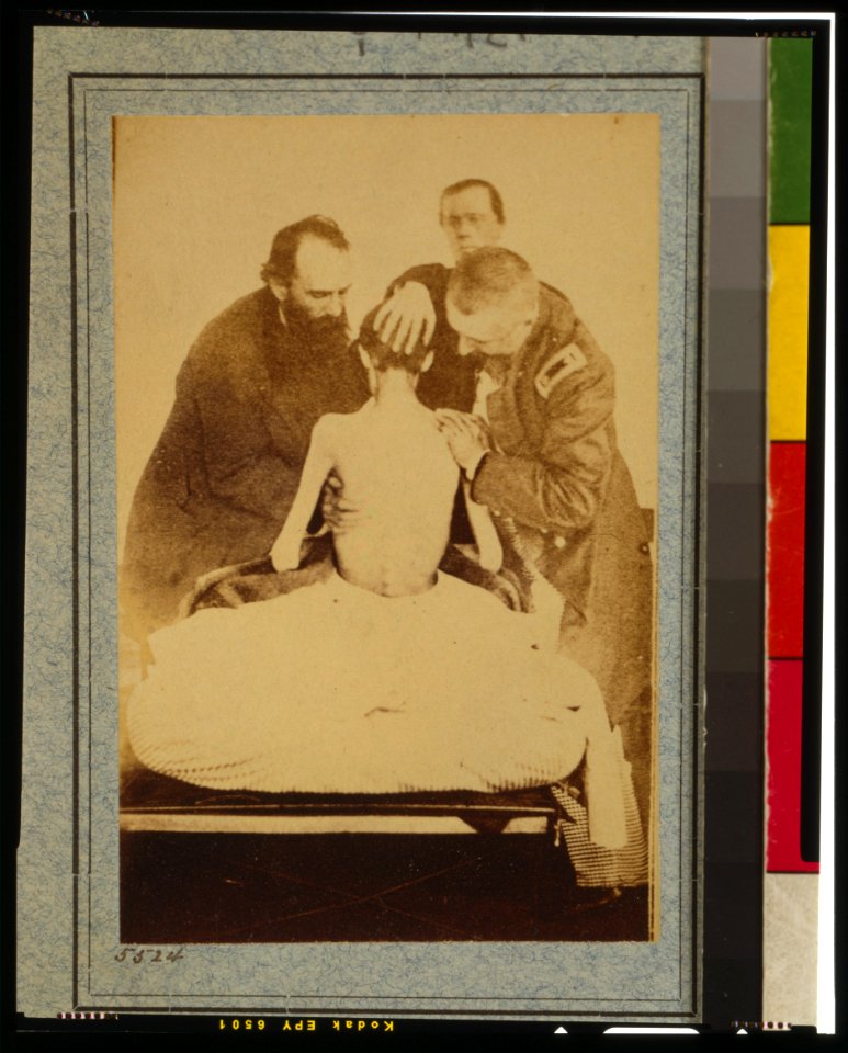Emaciated prisoner of war from Belle Isle, Richmond, Private Isaiah G. Bowker of Co. B, 9th Maine Volunteers, at the U.S. General Hospital, Div. 1, Annapolis LCCN2013645511
