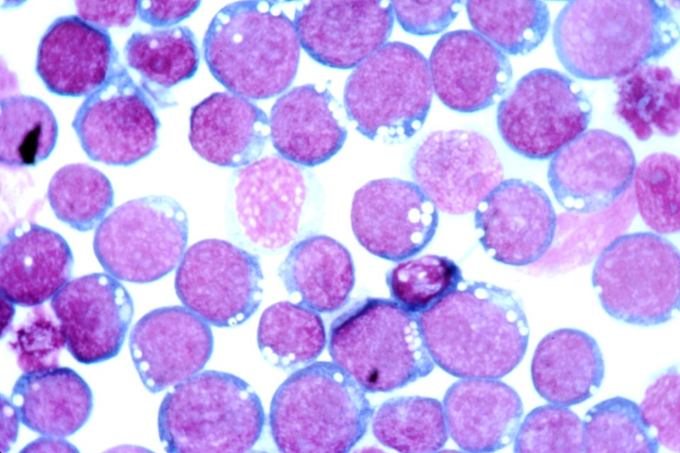 Epstein-barr virus (ebv)