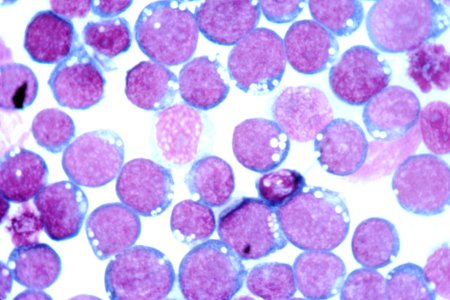 Epstein-barr virus (ebv)
