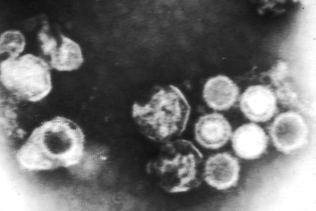 Epstein-barr virus