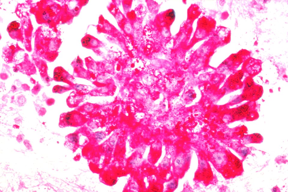 Ewing's sarcoma in the pleural fluid