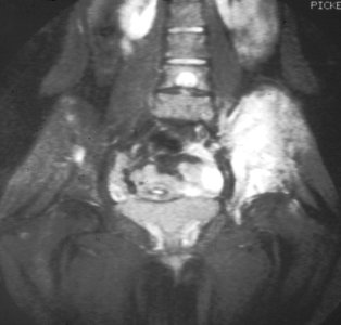 Ewing's sarcoma MRI nci-vol-1832-300 photo