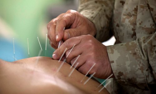 Flickr - Official U.S. Navy Imagery - Cmdr. Yevsey Goldberg conducts an acupuncture procedure.