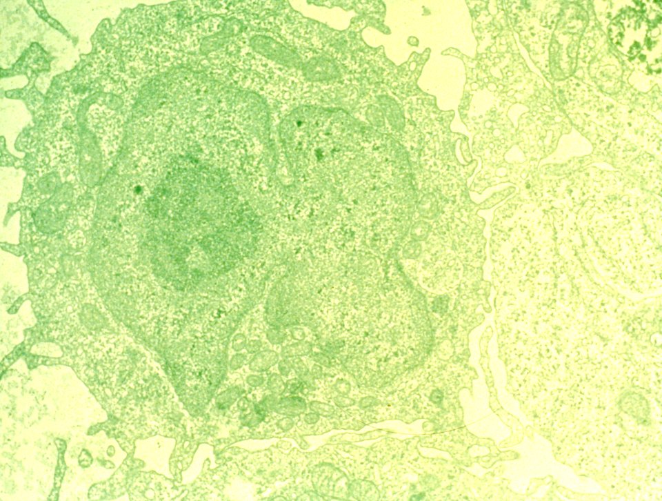 Hairy cell leukemia (2)