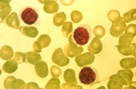 Hairy cell leukemia (1)
