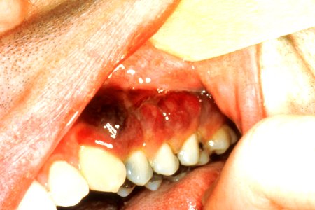 Intraoral Kaposi's sarcoma