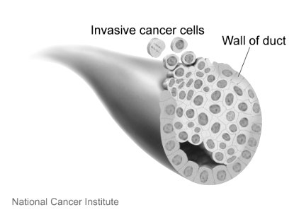 Invasive breast cancer photo