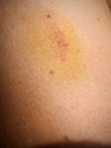 Haematoma discoloration skin