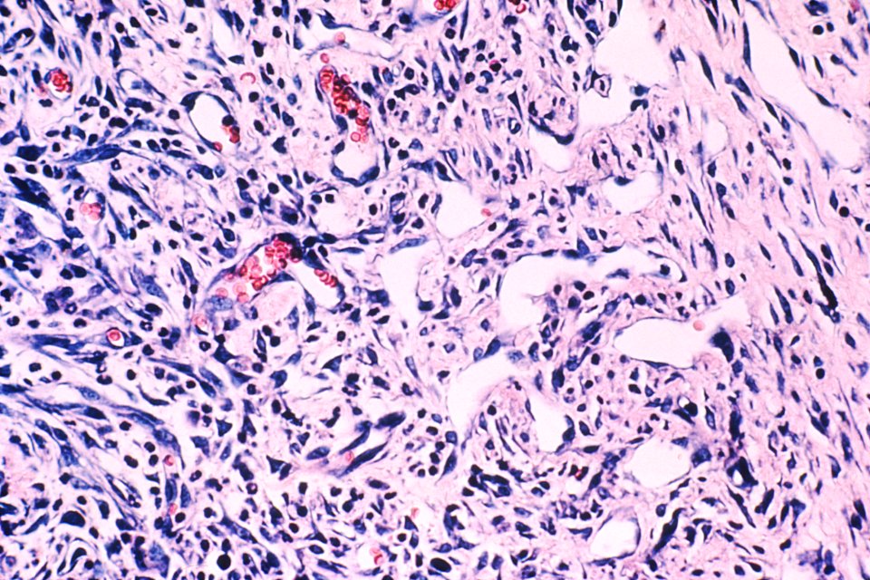 Kaposi's sarcoma (1)