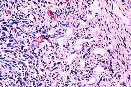 Kaposi's sarcoma (1)