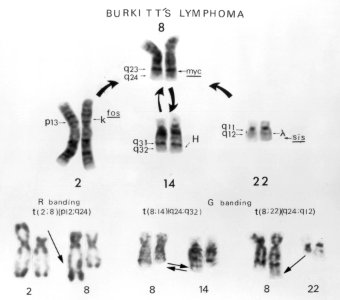 Karyotype- burkitt's lymphoma