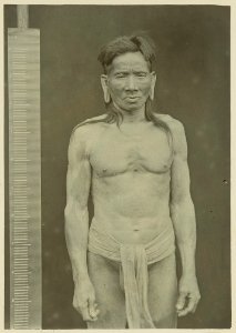 KITLV - 25683 - Demmeni, J. - Sulang Edóh, elderly Kayan man of about 50 years old, covered with Tinea Imbricata, a fungal skin disease - 1898-1900