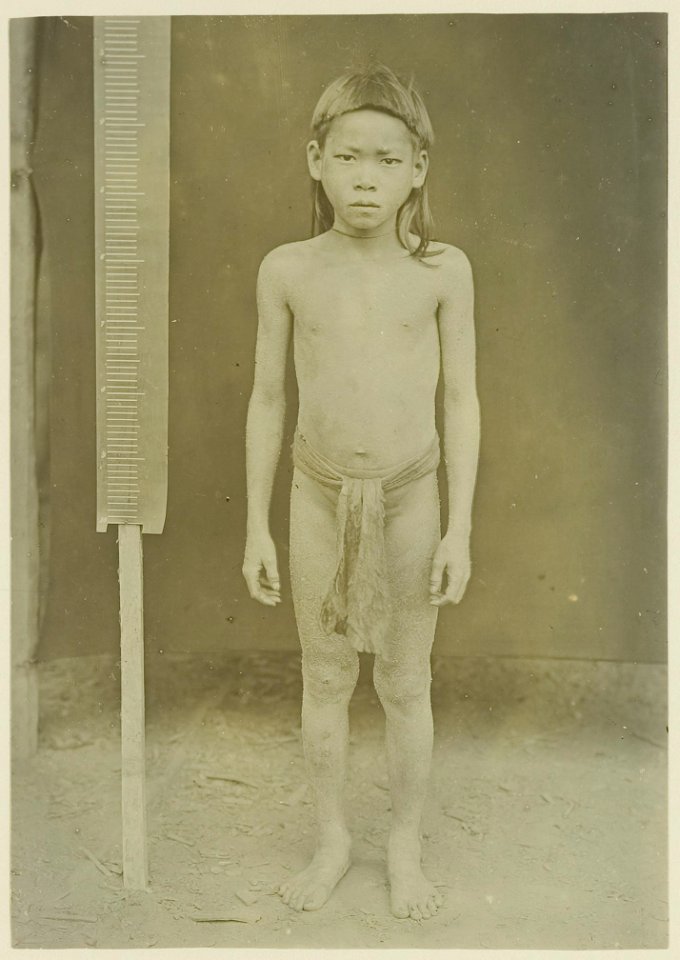 KITLV - 25681 - Demmeni, J. - Beeng Oenjang, a Kayan boy about 10 years old completely covered with the skin disease Tinea Imbricata, Upper Mahakam, Central Borneo - 1898-1900
