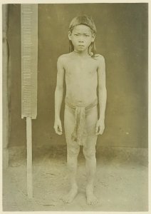 KITLV - 25681 - Demmeni, J. - Beeng Oenjang, a Kayan boy about 10 years old completely covered with the skin disease Tinea Imbricata, Upper Mahakam, Central Borneo - 1898-1900