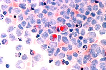 Leukemia (aml)