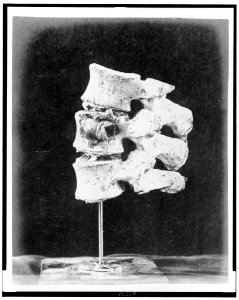 Lower half of right femur, with ball impacted above the inner condyle LCCN96522260