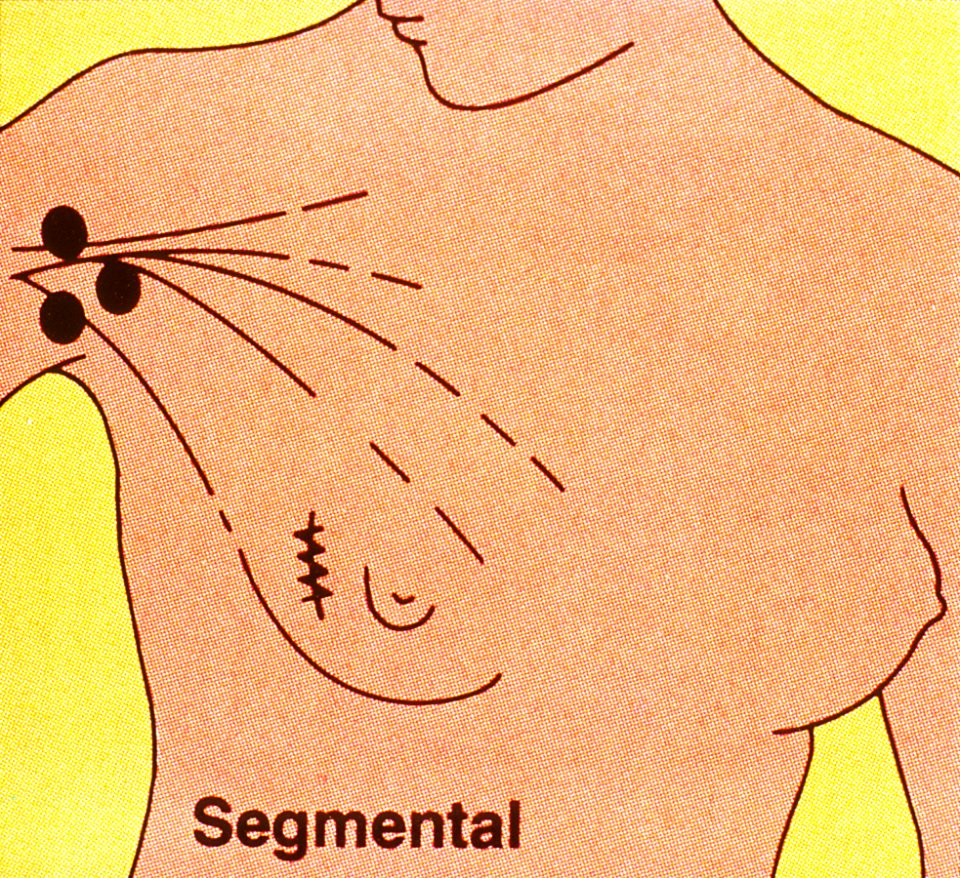 Lumpectomy illustration