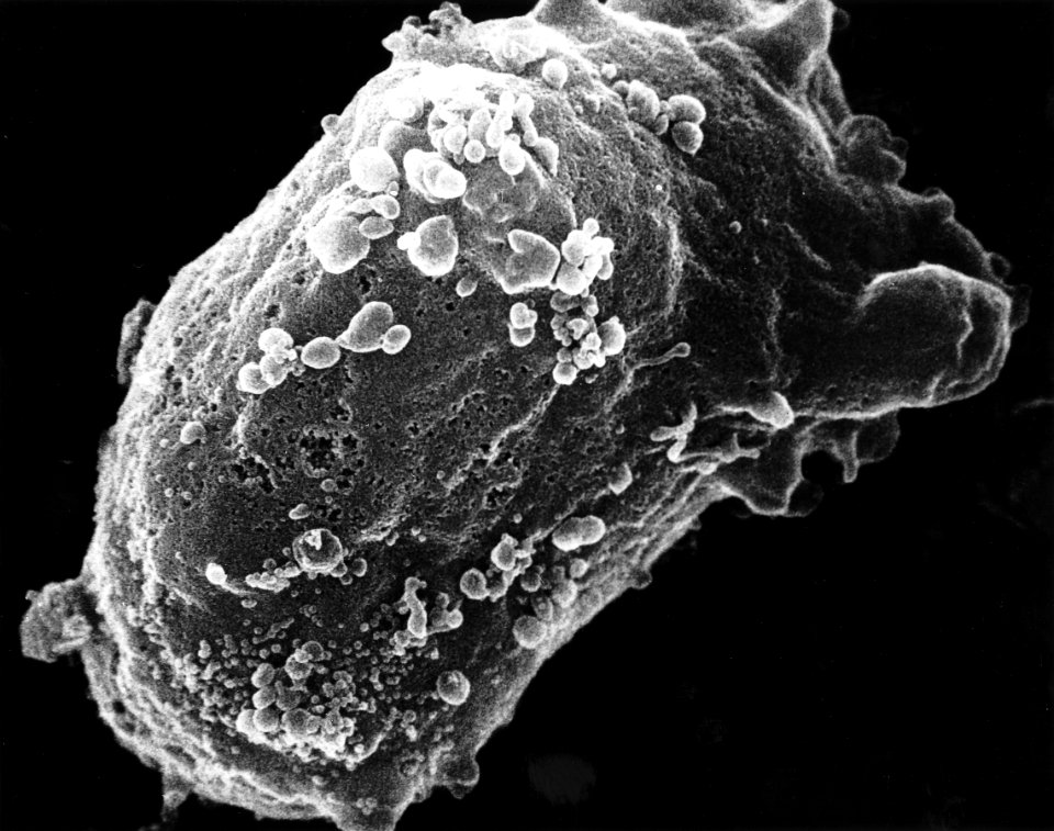 Lymphocyte with HIV cluster
