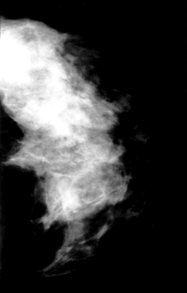 Mammogram showing fibrocystic disease
