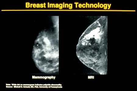 Mammogram vs. MRI photo