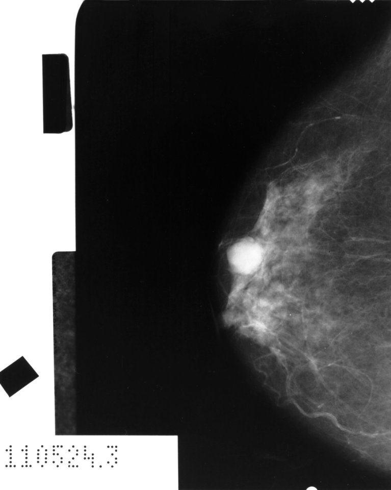 Mammogram showing cancer photo