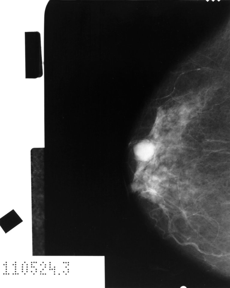 Mammogram showing cancer