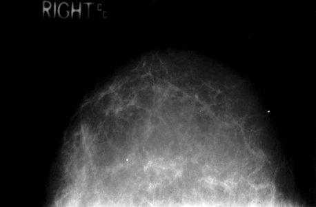 Mammogram showing normal fatty breast