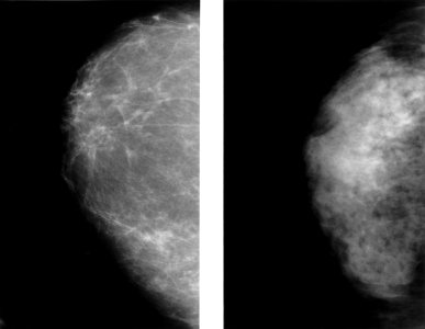 Mammogram showing dense and fatty breasts photo