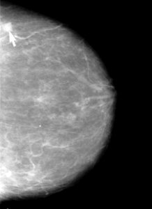 Mammogram showing small lesion