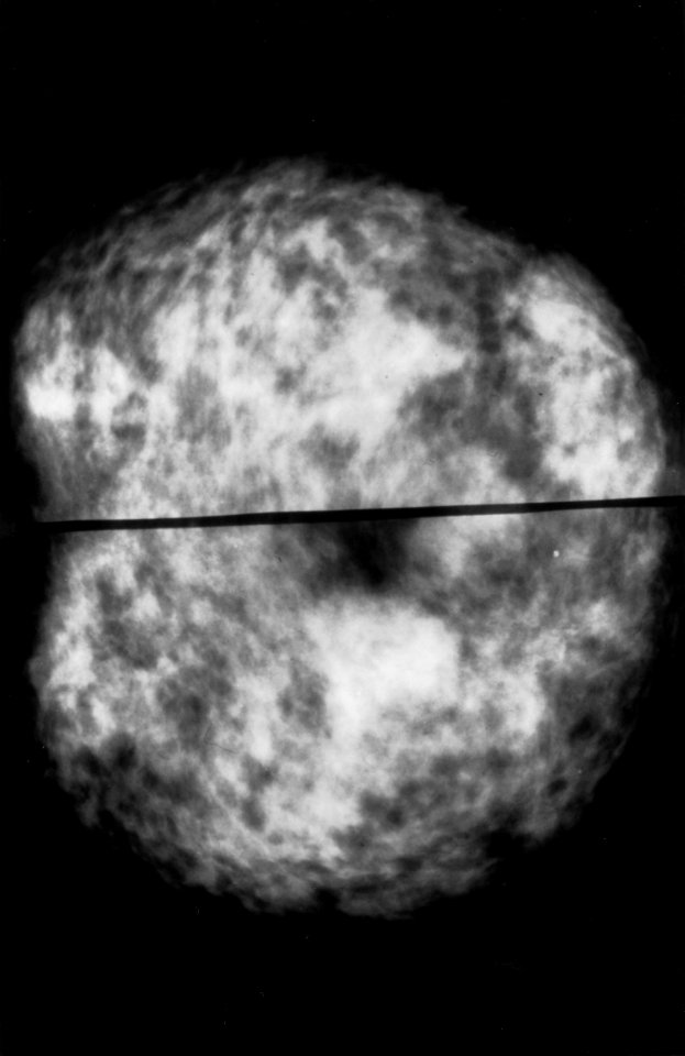 Mammogram showing normal dense breasts