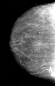 Mammogram with obvious cancer photo