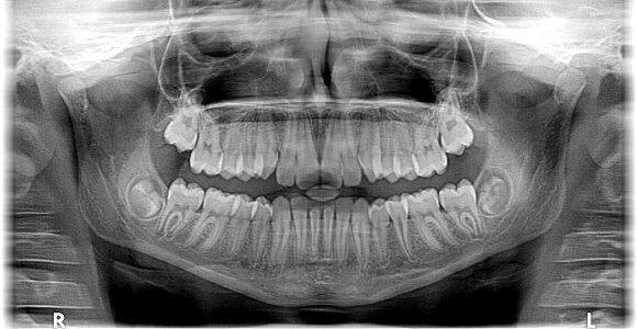 Roentgen teeth jaw photo
