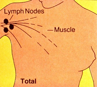 Mastectomy (simple)