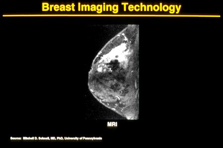 Mri of breast cancer photo